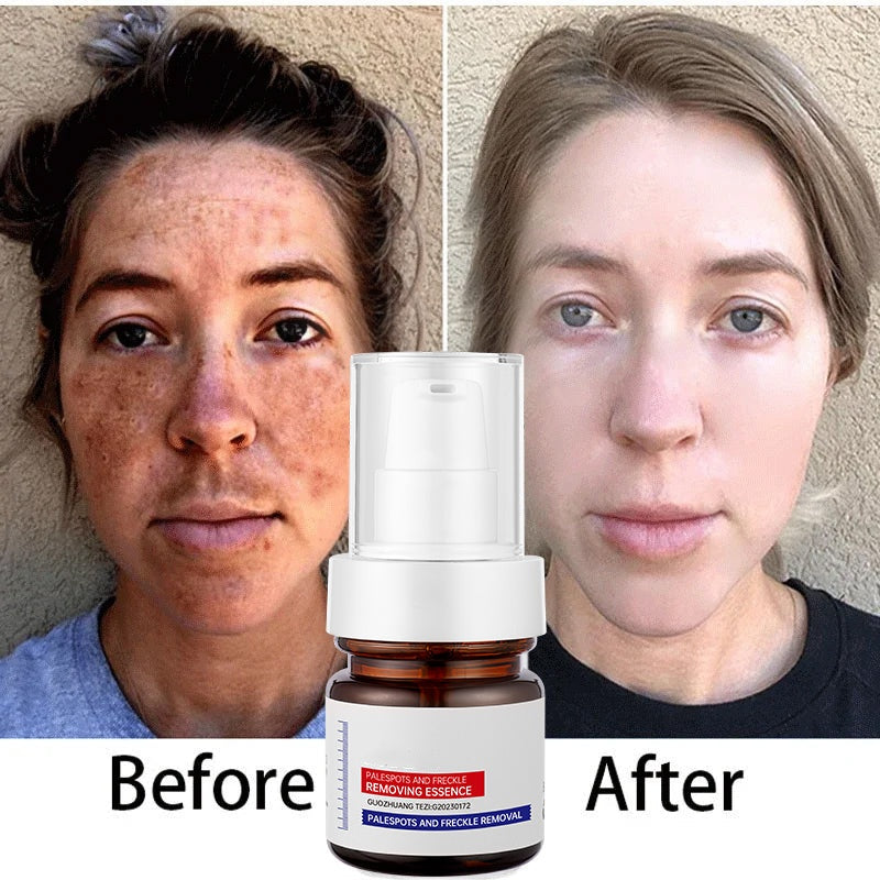 Vitamin C Whitening Freckles ESSENCE：Dark spots disappear, blemishes fade, and skin becomes radiant!