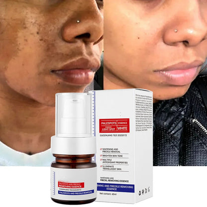 Vitamin C Whitening Freckles ESSENCE：Dark spots disappear, blemishes fade, and skin becomes radiant!